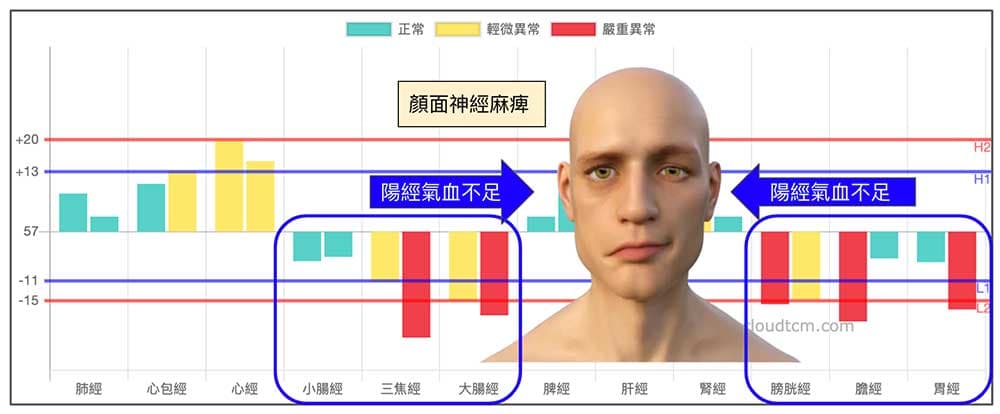 陽經氣血不足造成面癱