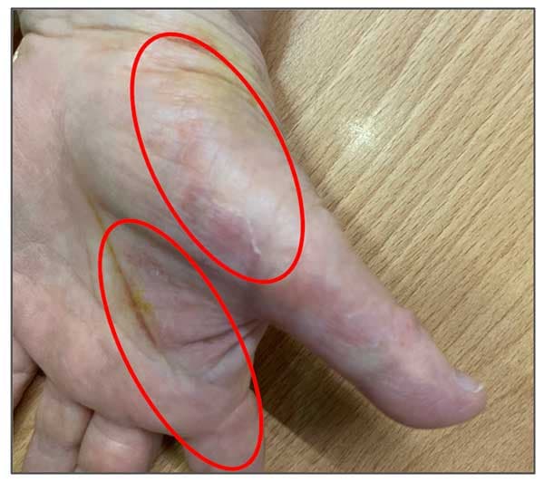 某人出現汗皰疹的位置，就是在肺經與大腸經上