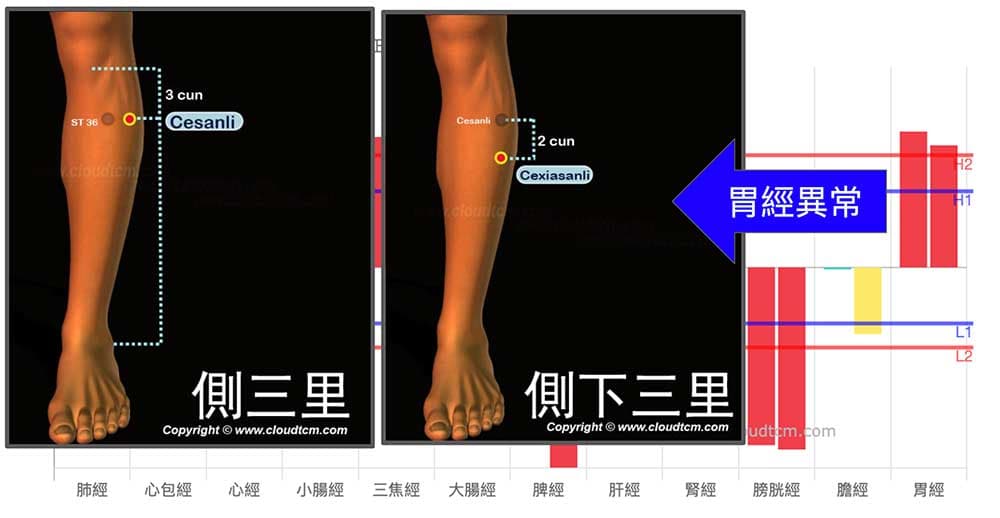 董氏奇穴可改善三叉神經痛