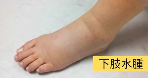 下肢水腫