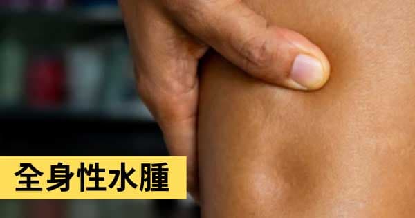 全身性水腫