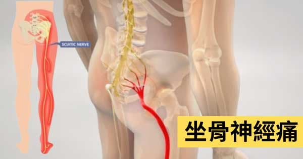 坐骨神經痛