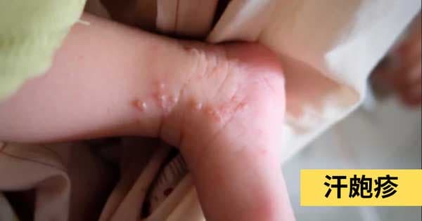 汗皰疹