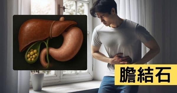 膽結石