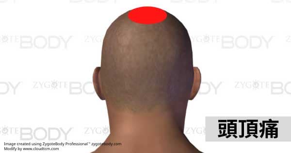 頭頂痛