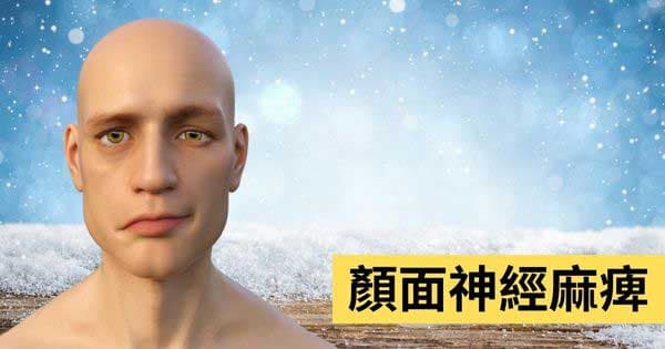 顏面神經麻痺