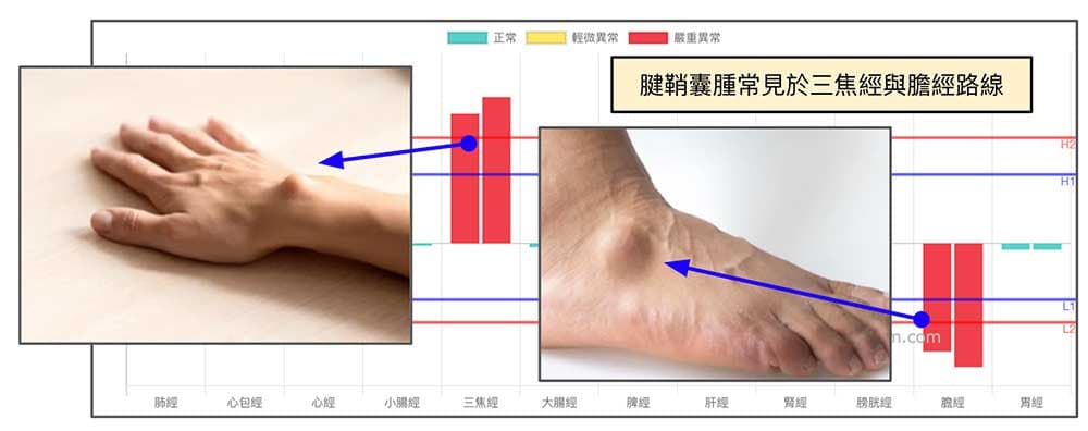 三焦經與膽經容易出現腱鞘囊腫