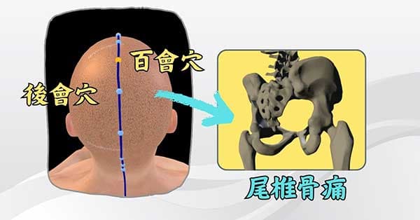 董氏奇穴的「後會穴」可以改善尾椎骨痛