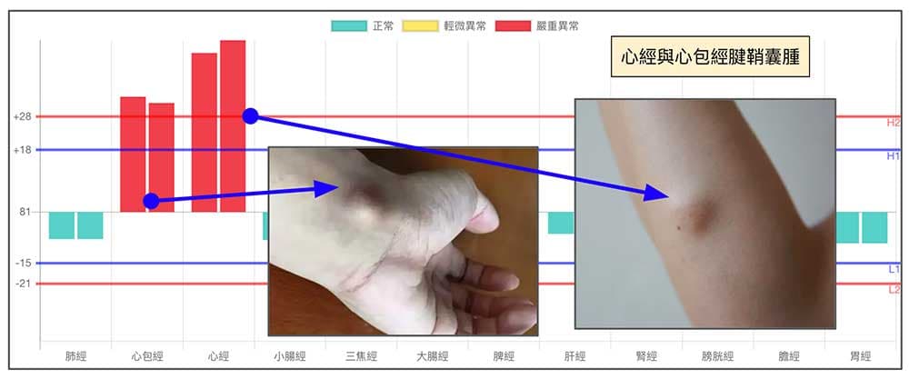 心經與心包經路線上出現腱鞘囊腫