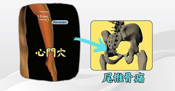 董氏奇穴的「心門穴」可以改善尾椎骨痛