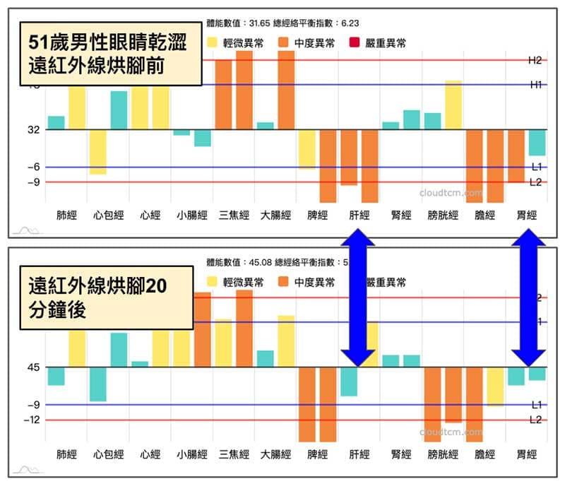 某會員眼睛乾澀，分享經絡圖比較遠紅外線烘腳前後改變