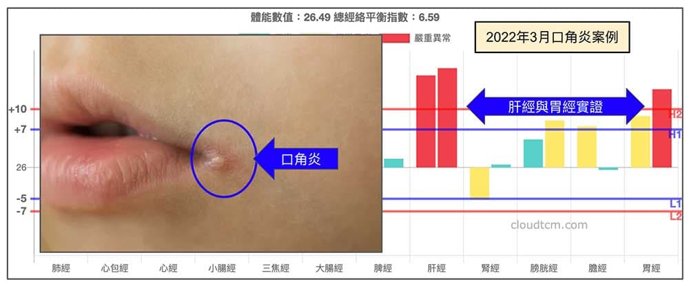 肝經與胃經實證，出現口角炎案例