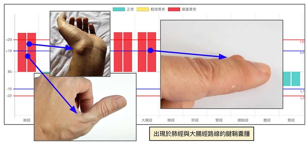 腱鞘囊腫也容易出現在肺經與大腸經上