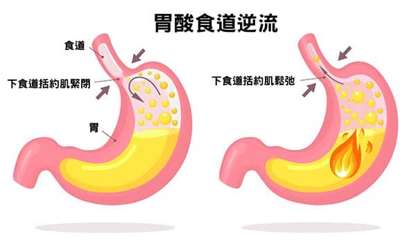 胃食道逆流是下食道括約肌鬆弛造成