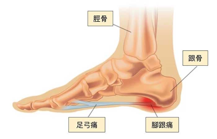 腳內側足弓痛從中醫證候 經絡與中藥理解！ 雲端中醫養生
