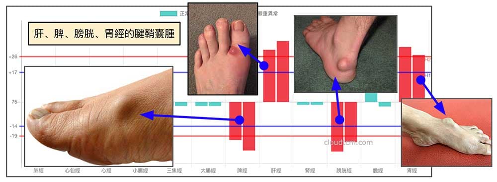 鐵三角經絡型態出現的囊腫位置，就在這些經絡路線上