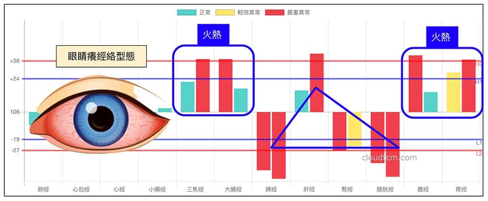 鐵三角經絡型態的變化型，最容易出現眼睛癢