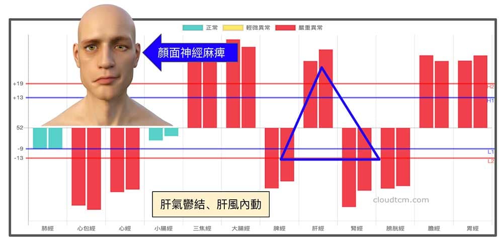 鐵三角經絡型態與面癱