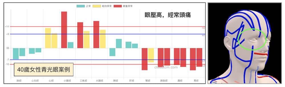 40歲青光眼，眼壓高頭痛案例