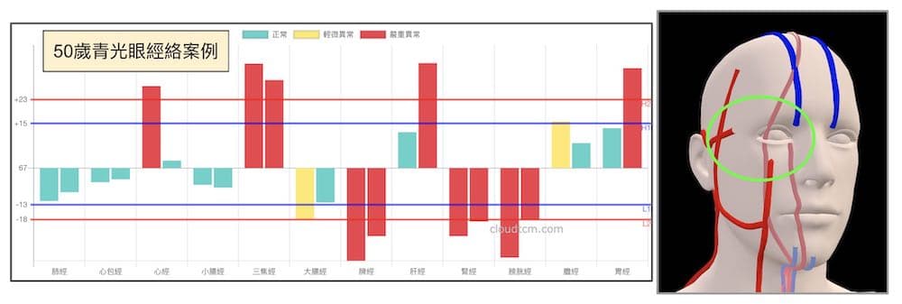 50歲女性青光眼案例