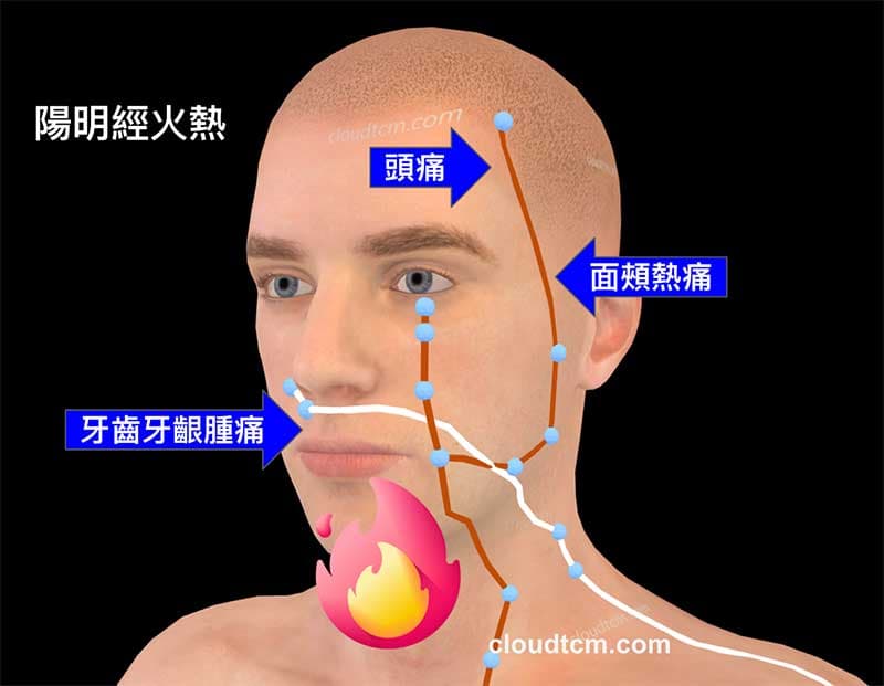 陽明經火熱出現牙痛,頭痛