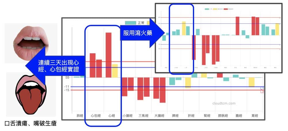 運用經絡檢測快速證明瀉火中藥的效果