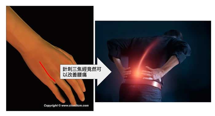 針刺手上的三焦經，竟然可以治療腰痛