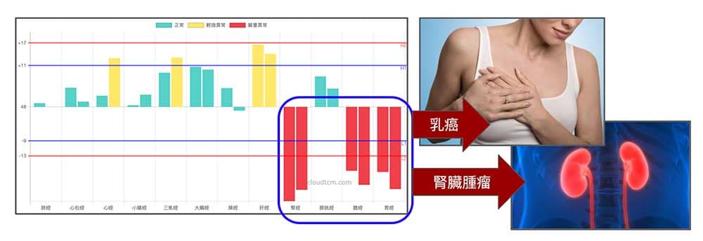 同樣的經絡型態，陸續出現兩種不同的腫瘤