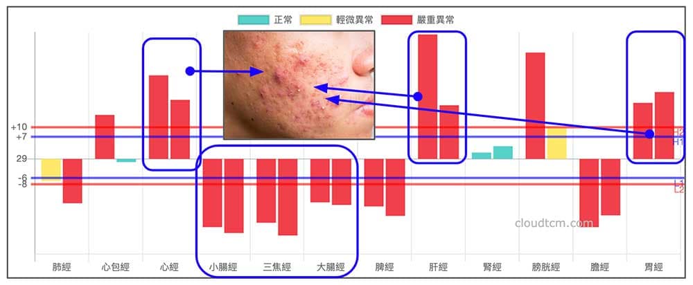 冬天手三陽經虛證，臉上卻長滿痘子