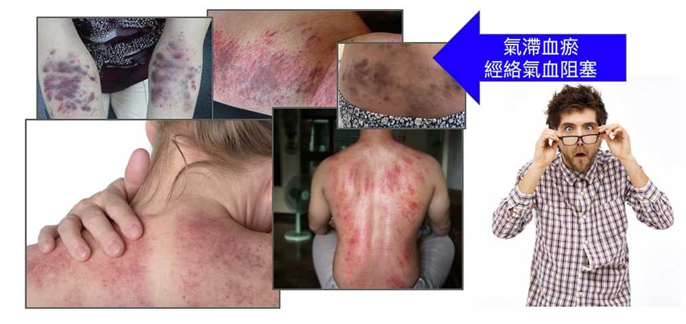 透過刮痧拔罐與拍打，可以清楚呈現中醫所說的氣滯血瘀