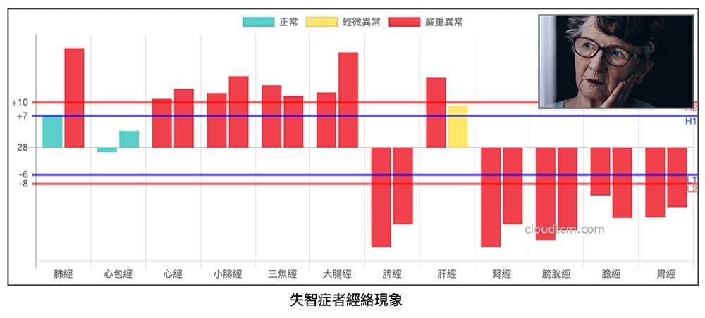 失智症經絡現象，出現上實下虛經絡型態