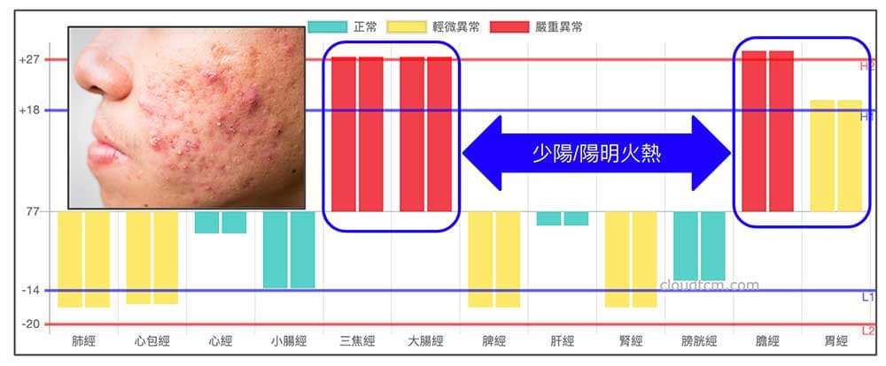 春夏期間經常出現面皰的經絡現象