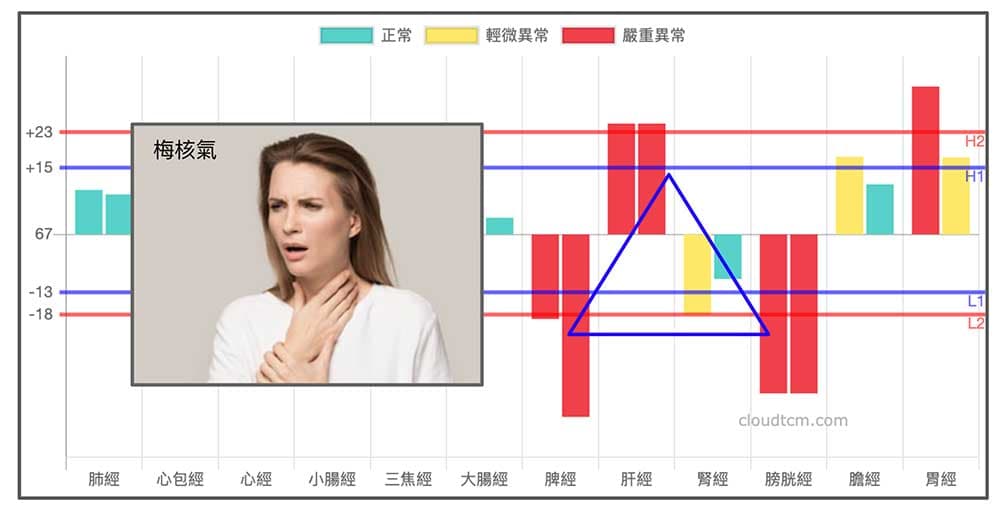 梅核氣常見的經絡型態，就是夏天常出現的經絡型態