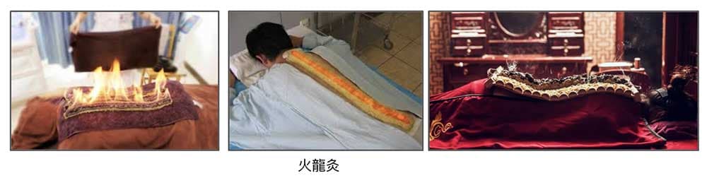 火龍灸