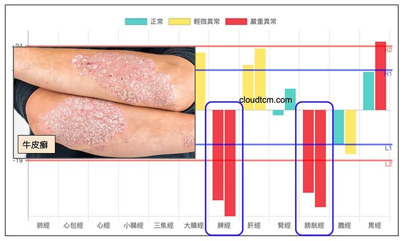 牛皮癬(銀屑病)與鐵三角經絡型態密切相關