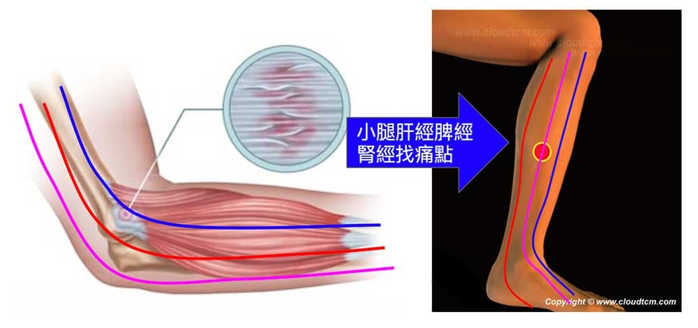 改善網球肘可以在腳上的肝經、脾經與腎經上找痛點按摩