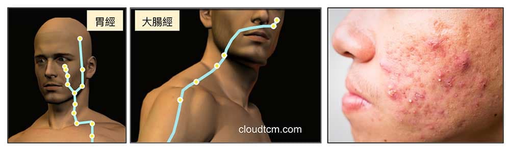 面皰經常出現在胃經與大腸經路線上