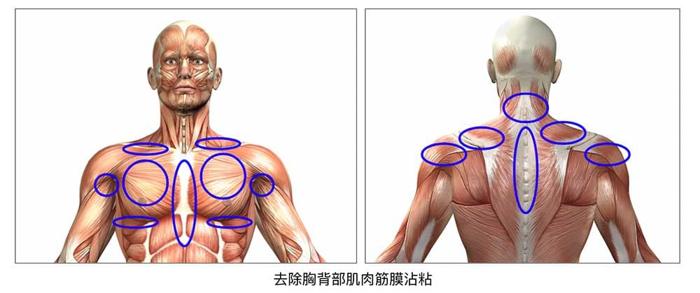 去除胸背肌肉沾粘之後，心胸部位不舒服症狀大幅改善