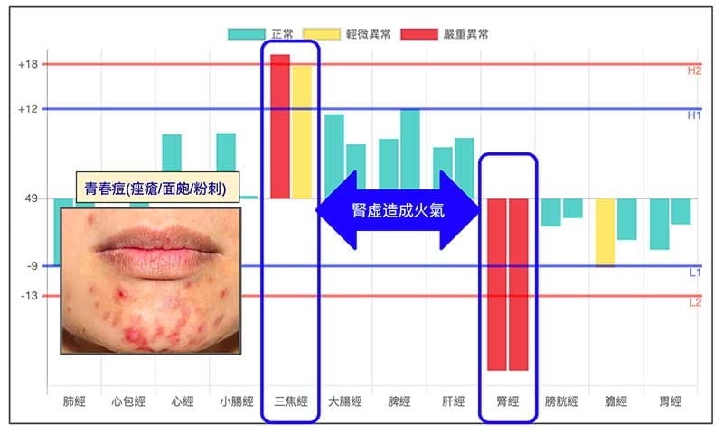 腎經虛證造成虛火，容易在臉上出現青春痘