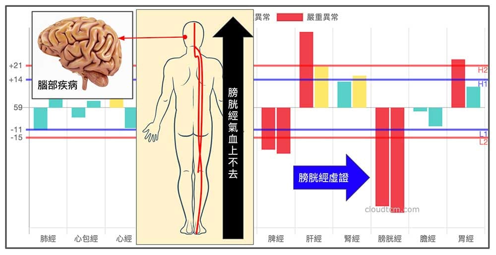 腦中風患者，通常膀胱經能量都是虛證(氣血不足)