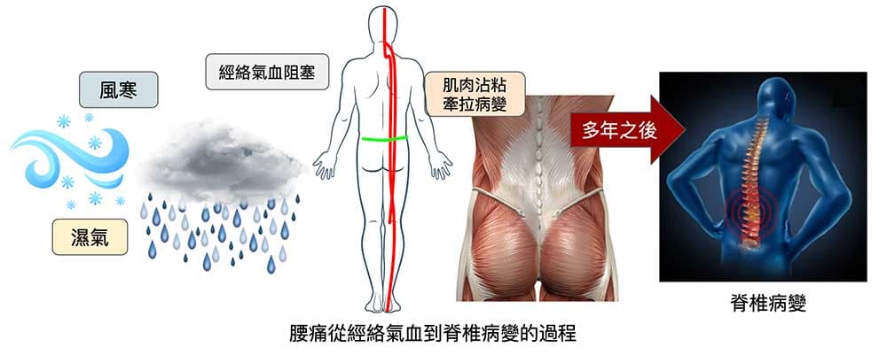 脊椎病變是疾病演變到後期的階段