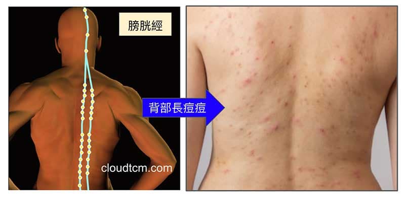 全身氣血瘀阻，痘痘會反應在膀胱經上