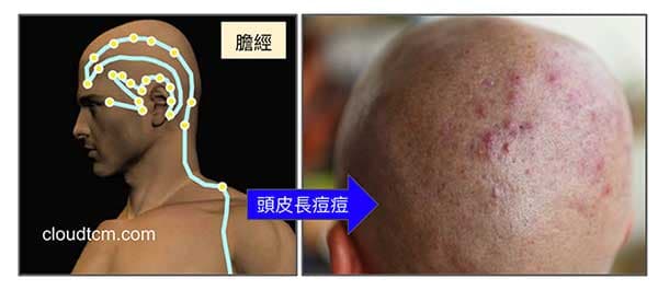 膽經火氣讓頭皮也會長痘痘