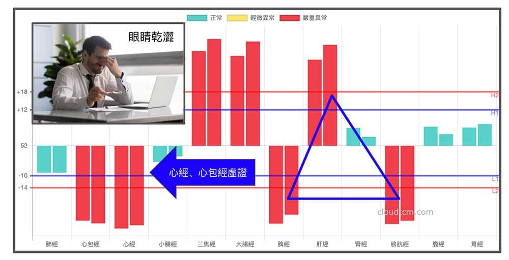 鐵三角經絡型態的其中一種變化型，很容易出現乾眼症