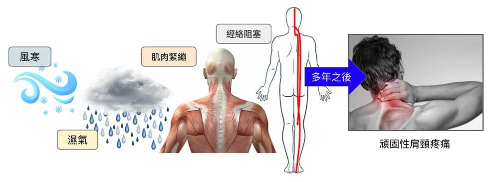 難治性肩頸痛，必須累積多年之功力才得以形成