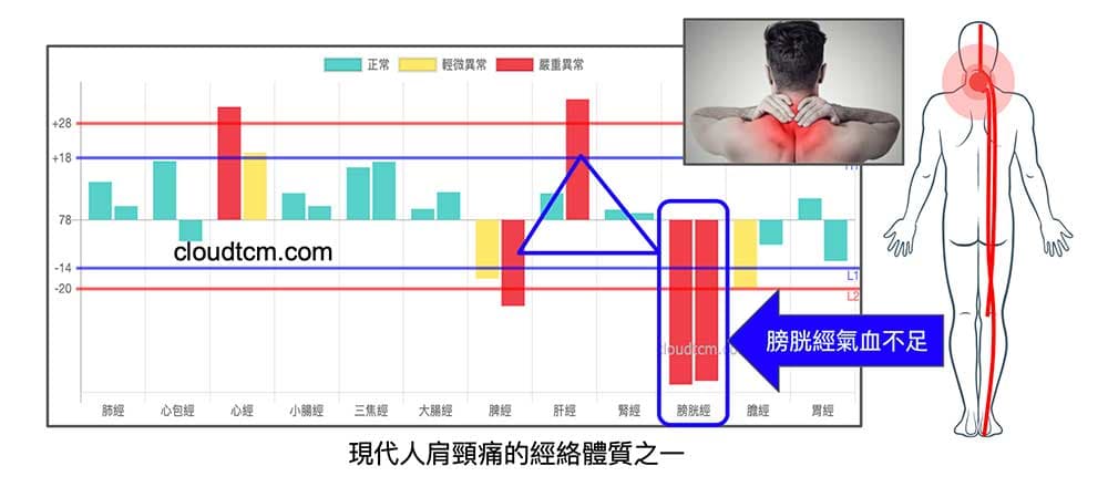 現代人經常脖子痛的常見經絡體質之一