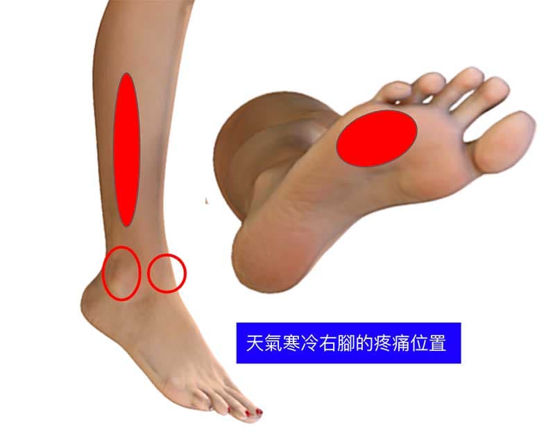 天氣寒冷當天，右腳出現疼痛的位置