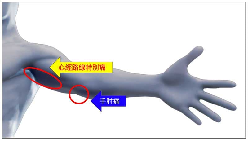 高爾夫球肘痛，在心經路線上特別疼痛