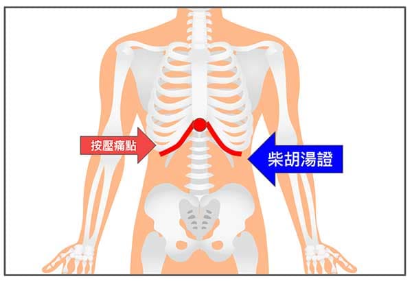 按壓胸骨劍突，肋骨附近疼痛是柴湖湯證