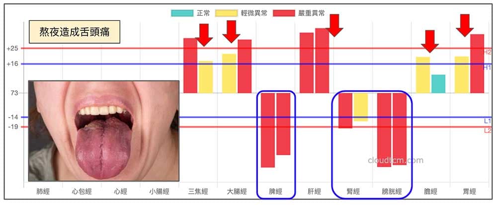 熬夜舌頭痛